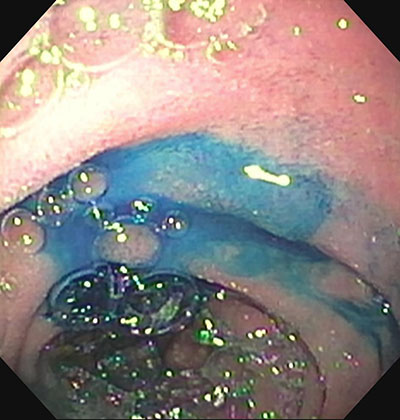 Blue dye in liver lymphatic system used to diagnose Protein-losing enteropathy (PLE)